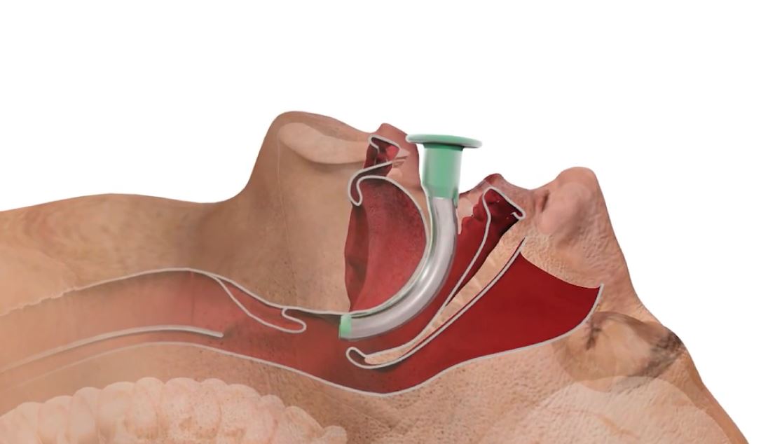 Immediate Life Support in Dental Sedation (LIDS) course from UKSedation - 3 hours face to face ILS equivalent